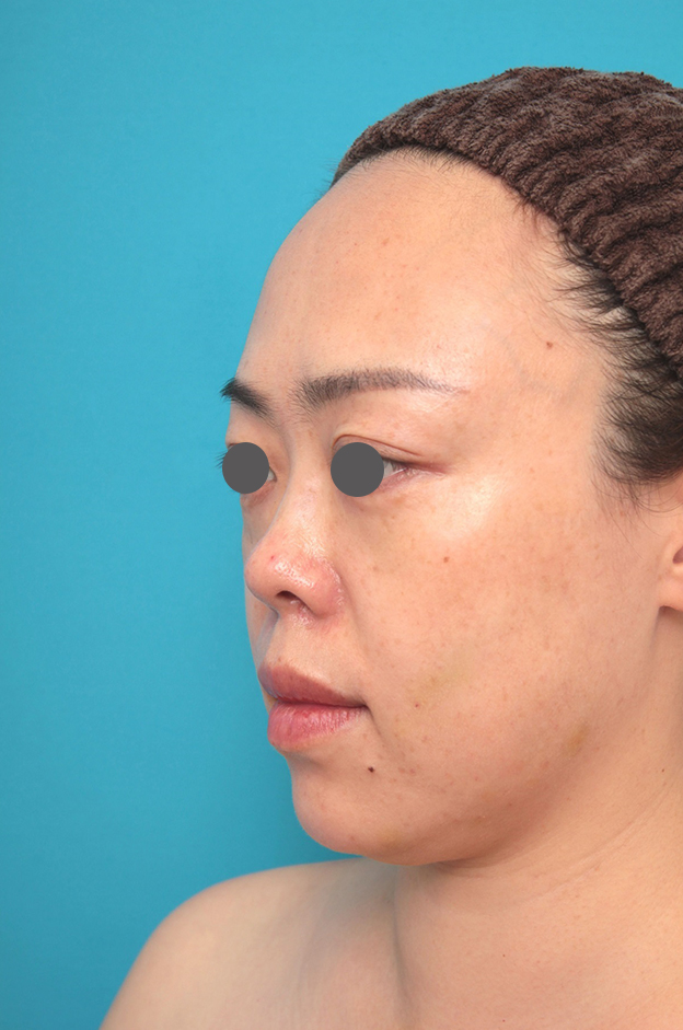 耳介軟骨移植（鼻先を出す）,鼻プロテーゼ、耳介軟骨移植の症例写真,施術前,mainpic_ryubi1058e.jpg