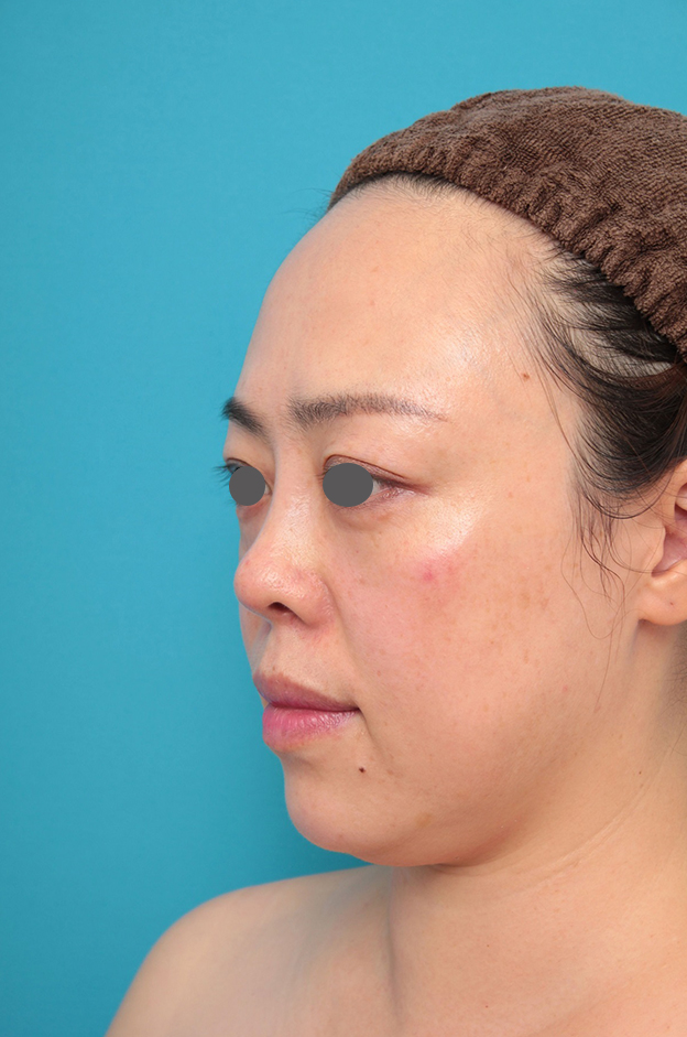 耳介軟骨移植（鼻先を出す）,鼻プロテーゼ、耳介軟骨移植の症例写真,1ヶ月後,mainpic_ryubi1058g.jpg