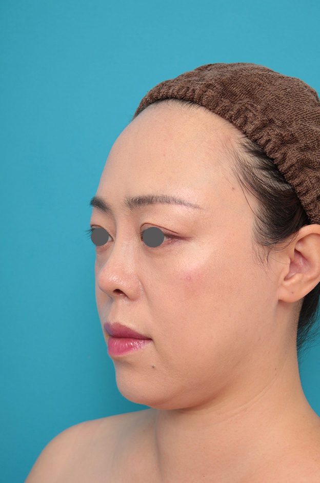 隆鼻術（シリコンプロテーゼ）,鼻プロテーゼ、耳介軟骨移植の症例写真,1ヶ月後,mainpic_ryubi1058h.jpg
