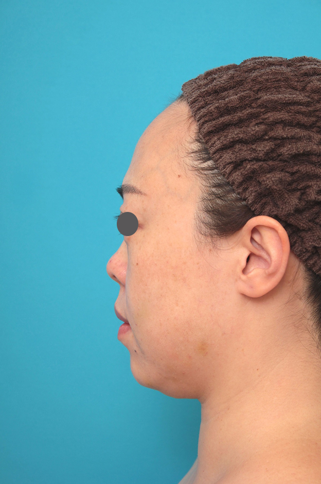 耳介軟骨移植（鼻先を出す）,鼻プロテーゼ、耳介軟骨移植の症例写真,施術前,mainpic_ryubi1058i.jpg