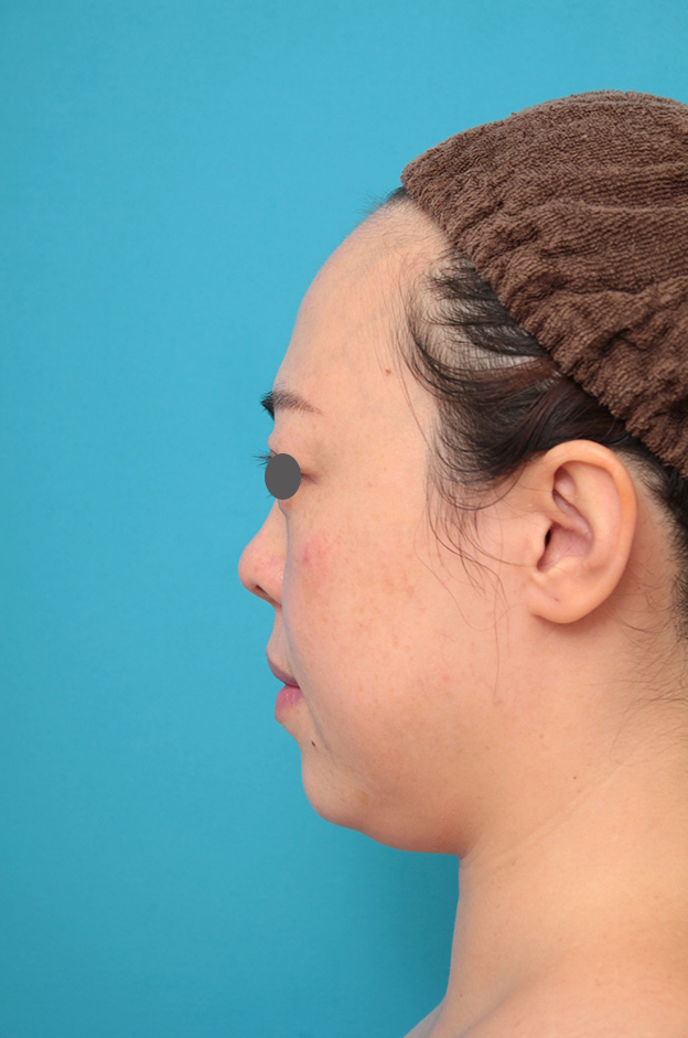 耳介軟骨移植（鼻先を出す）,鼻プロテーゼ、耳介軟骨移植の症例写真,1ヶ月後,mainpic_ryubi1058k.jpg