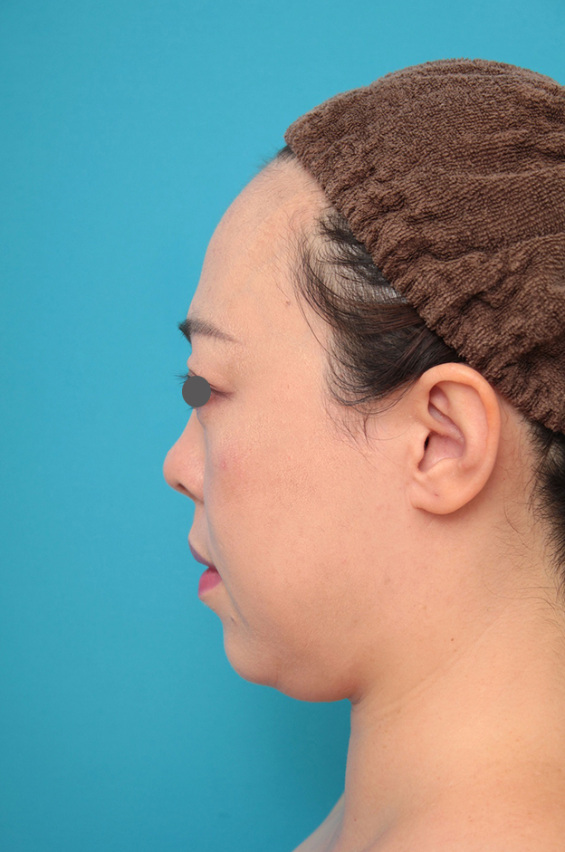 耳介軟骨移植（鼻先を出す）,鼻プロテーゼ、耳介軟骨移植の症例写真,1ヶ月後,mainpic_ryubi1058l.jpg
