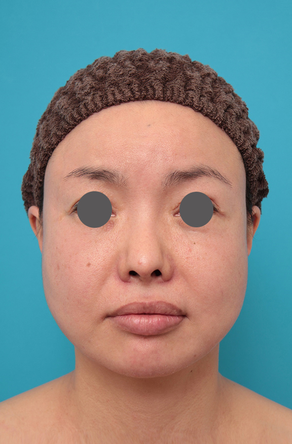 鼻中隔延長（鼻先を大きく下方に延ばす）,鼻中隔延長、鼻翼縮小の症例写真,After（6ヶ月後）,ba_bichukaku006_b01.jpg