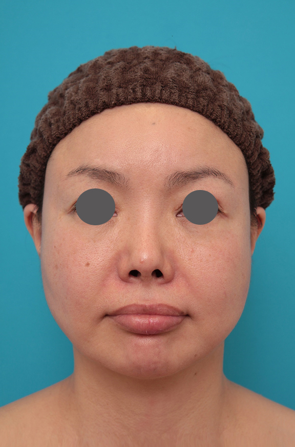 鼻中隔延長（鼻先を大きく下方に延ばす）,鼻中隔延長、鼻翼縮小の症例写真,Before,ba_bichukaku006_b01.jpg