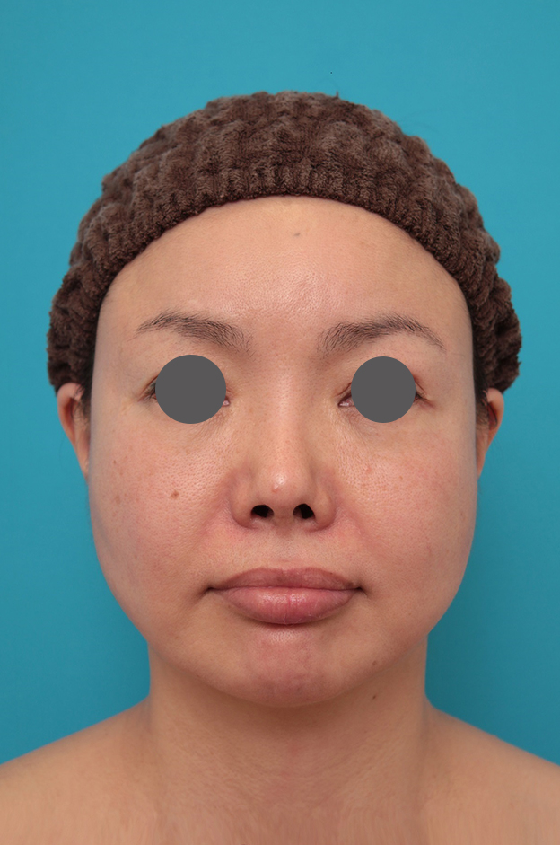 鼻翼縮小（小鼻縮小）,鼻中隔延長、鼻翼縮小の症例写真,施術前,mainpic_bichukaku006a.jpg