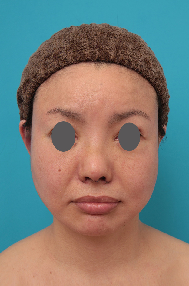 鼻中隔延長（鼻先を大きく下方に延ばす）,鼻中隔延長、鼻翼縮小の症例写真,3日後,mainpic_bichukaku006b.jpg