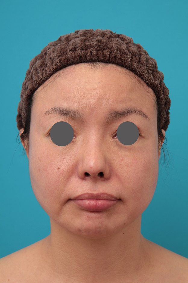 鼻翼縮小（小鼻縮小）,鼻中隔延長、鼻翼縮小の症例写真,1ヶ月後,mainpic_bichukaku006c.jpg