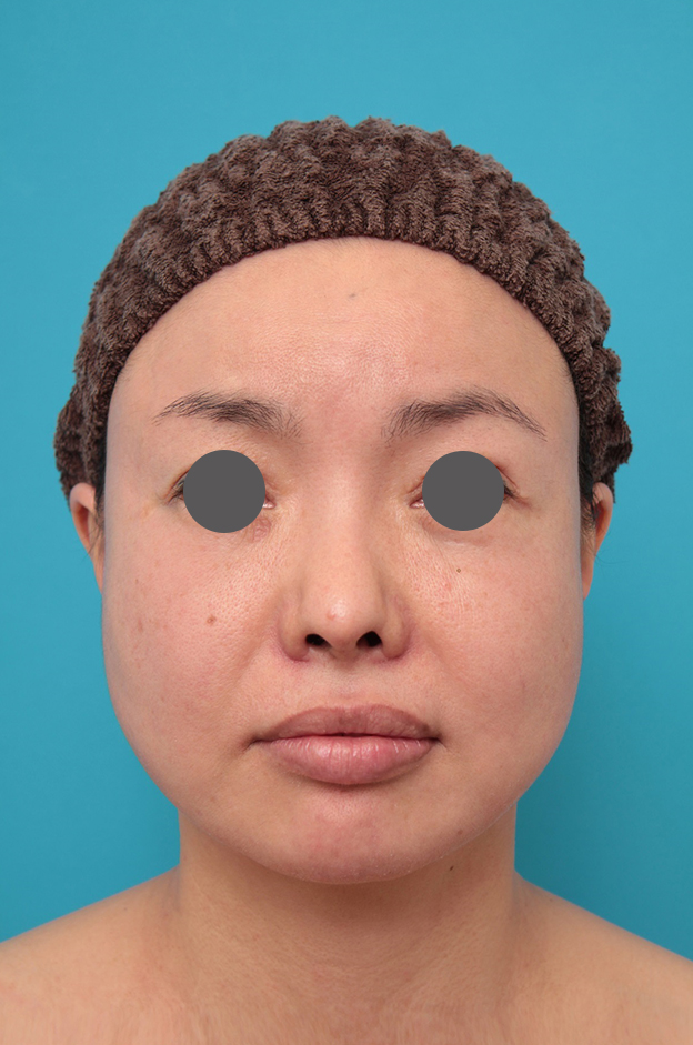 鼻中隔延長（鼻先を大きく下方に延ばす）,鼻中隔延長、鼻翼縮小の症例写真,6ヶ月後,mainpic_bichukaku006d.jpg