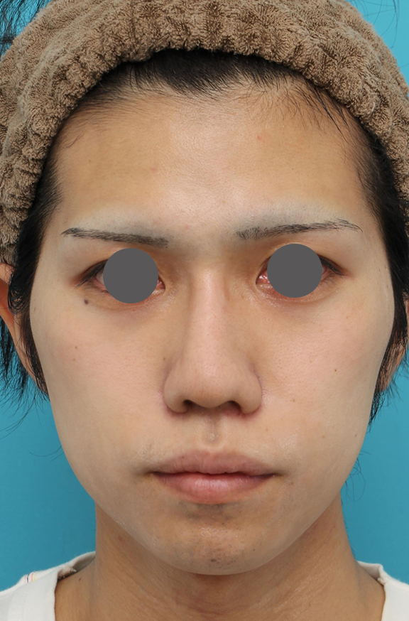 隆鼻術（シリコンプロテーゼ）,隆鼻術（シリコンプロテーゼ）、あご形成（シリコンプロテーゼ）、鼻翼縮小（小鼻縮小）の症例写真,After（1ヶ月後）,ba_ryubi1059_b01.jpg