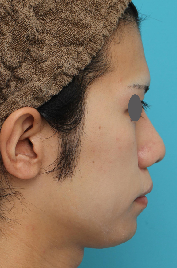 隆鼻術（シリコンプロテーゼ）,隆鼻術（シリコンプロテーゼ）、あご形成（シリコンプロテーゼ）、鼻翼縮小（小鼻縮小）の症例写真,After（1ヶ月後）,ba_ryubi1059_b02.jpg