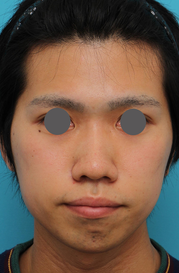 隆鼻術（シリコンプロテーゼ）,隆鼻術（シリコンプロテーゼ）、あご形成（シリコンプロテーゼ）、鼻翼縮小（小鼻縮小）の症例写真,Before,ba_ryubi1059_b01.jpg