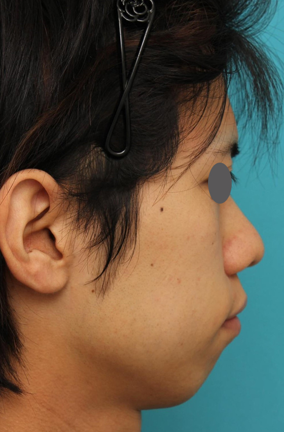 鼻翼縮小（小鼻縮小）,隆鼻術（シリコンプロテーゼ）、あご形成（シリコンプロテーゼ）、鼻翼縮小（小鼻縮小）の症例写真,Before,ba_ryubi1059_b02.jpg