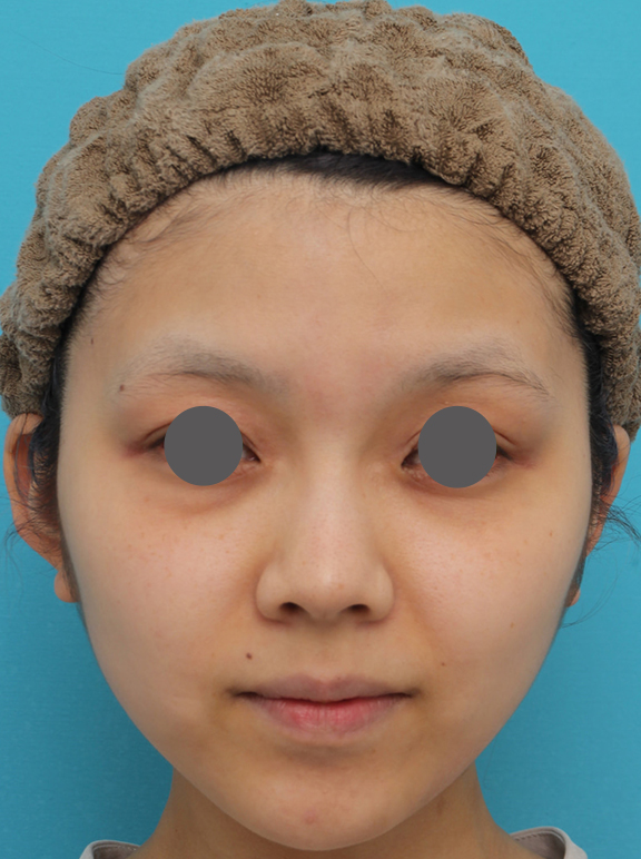 鼻翼縮小（小鼻縮小）,鼻翼縮小（小鼻縮小）の症例写真　術後6ヶ月の経過,After（6ヶ月後）,ba_biyoku052_b01.jpg