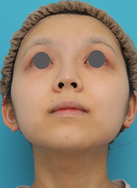 鼻翼縮小（小鼻縮小）,鼻翼縮小（小鼻縮小）の症例写真　術後6ヶ月の経過,After（6ヶ月後）,ba_biyoku052_b02.jpg