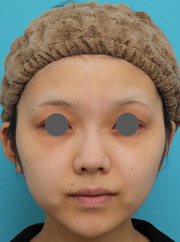 鼻翼縮小（小鼻縮小）,鼻翼縮小（小鼻縮小）の症例写真　術後6ヶ月の経過,Before,ba_biyoku052_b01.jpg