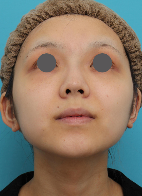 鼻翼縮小（小鼻縮小）,鼻翼縮小（小鼻縮小）の症例写真　術後6ヶ月の経過,Before,ba_biyoku052_b02.jpg
