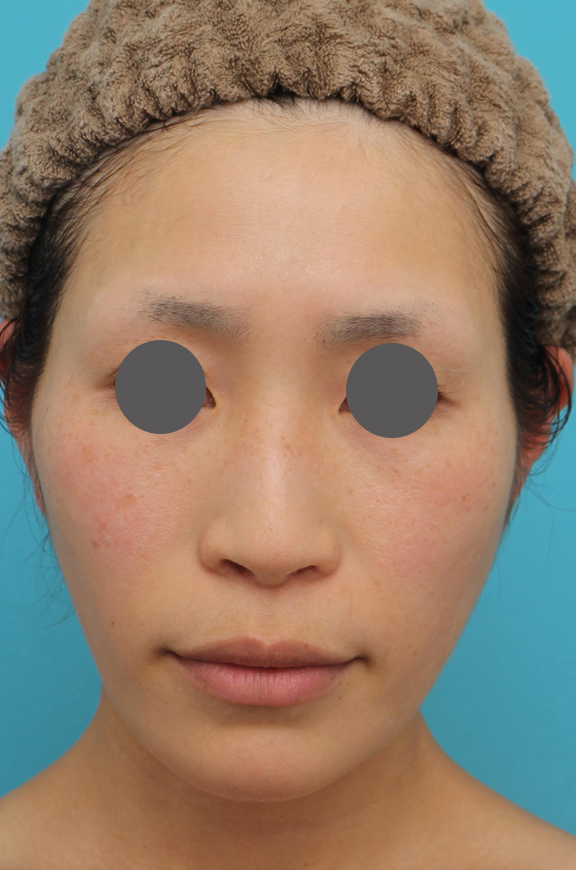 鼻の下を短く（上口唇短縮手術、上口唇リフト、リップリフト、人中短縮術）,人中短縮術、鼻翼縮小（小鼻縮小）の症例写真,After（6ヶ月後）,ba_hanashita001_b01.jpg