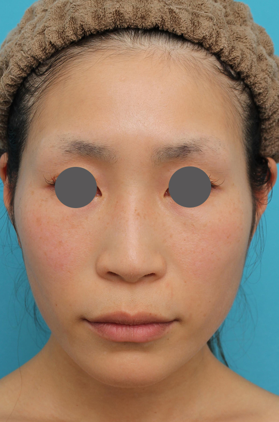 鼻の下を短く（上口唇短縮手術、上口唇リフト、リップリフト、人中短縮術）,人中短縮術、鼻翼縮小（小鼻縮小）の症例写真,Before,ba_hanashita001_b01.jpg