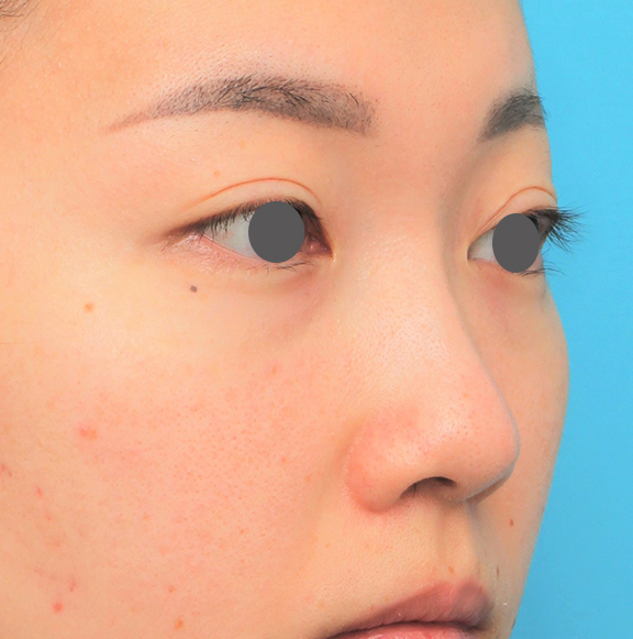 鼻翼縮小（小鼻縮小）,鼻尖縮小＋小鼻縮小＋鼻先、鼻柱の耳介軟骨移植＋鼻筋のヒアルロン酸注射の症例写真,After（6ヶ月後）,ba_bisen030_b02.jpg