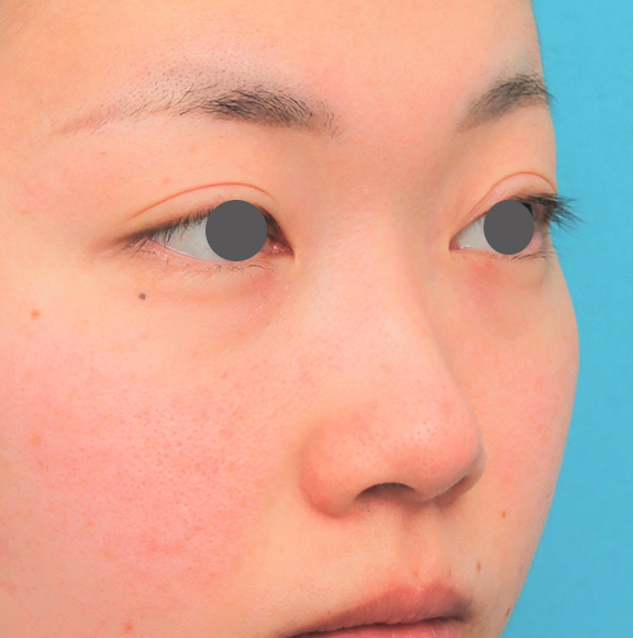 鼻翼縮小（小鼻縮小）,鼻尖縮小＋小鼻縮小＋鼻先、鼻柱の耳介軟骨移植＋鼻筋のヒアルロン酸注射の症例写真,Before,ba_bisen030_b02.jpg