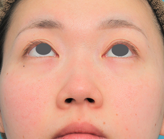 鼻翼縮小（小鼻縮小）,鼻尖縮小＋小鼻縮小＋鼻先、鼻柱の耳介軟骨移植＋鼻筋のヒアルロン酸注射の症例写真,Before,ba_bisen030_b04.jpg