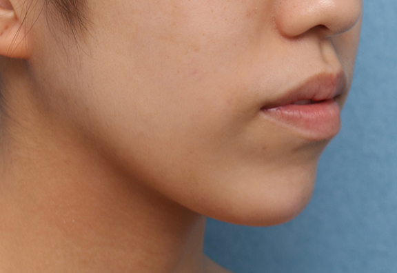 あご注射（ヒアルロン酸）,顎の長期作用型ヒアルロン酸注射の症例写真,After,ba_agochu018_b02.jpg
