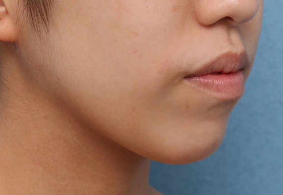 あご注射（ヒアルロン酸）,顎の長期作用型ヒアルロン酸注射の症例写真,Before,ba_agochu018_b02.jpg