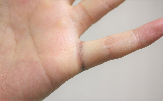 刺青（タトゥー）除去,指輪の模様の入れ墨のレーザー治療の症例写真,レーザー治療後1週間,mainpic_irezumi037c.jpg