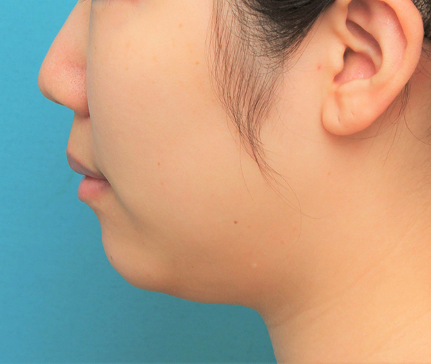 あご形成（シリコンプロテーゼ）,シリコンプロテーゼで顎を前に出してシャープな輪郭にした症例写真,手術前,mainpic_ago023f.jpg