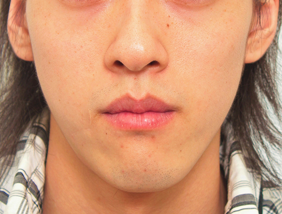 傷跡,顔の傷痕を修正手術した20代男性の症例写真,After（2年後）,ba_keisei001_b01.jpg