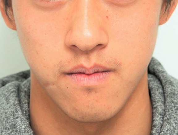 傷跡,顔の傷痕を修正手術した20代男性の症例写真,Before,ba_keisei001_b01.jpg
