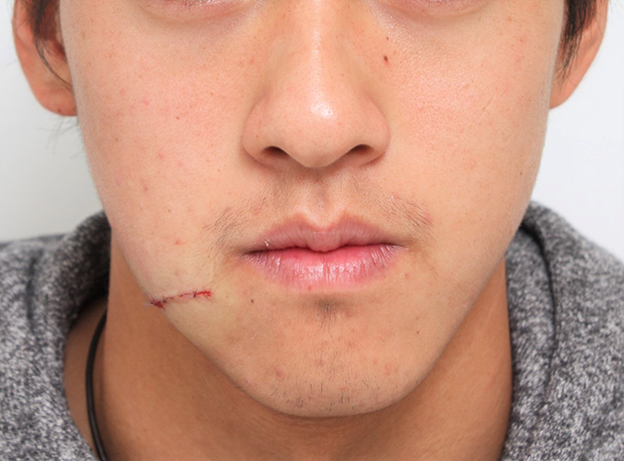傷跡,顔の傷痕を修正手術した20代男性の症例写真,手術直後,mainpic_keisei001b.jpg