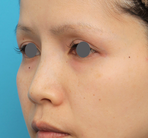 他院で受けた手術の修正（鼻）,隆鼻術（シリコンプロテーゼ）の症例 エンドプロテーゼ除去/シリコンプロテーゼ挿入,Before,ba_ryubi1060_b02.jpg