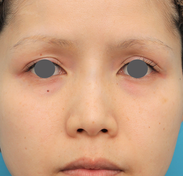 症例写真,隆鼻術（シリコンプロテーゼ）の症例 エンドプロテーゼ除去/シリコンプロテーゼ挿入,手術前,mainpic_ryubi1060a.jpg