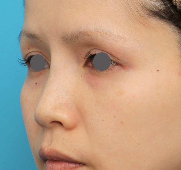 隆鼻術（シリコンプロテーゼ）,隆鼻術（シリコンプロテーゼ）の症例 エンドプロテーゼ除去/シリコンプロテーゼ挿入,手術前,mainpic_ryubi1060e.jpg