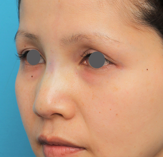 隆鼻術（シリコンプロテーゼ）,隆鼻術（シリコンプロテーゼ）の症例 エンドプロテーゼ除去/シリコンプロテーゼ挿入,手術直後,mainpic_ryubi1060f.jpg