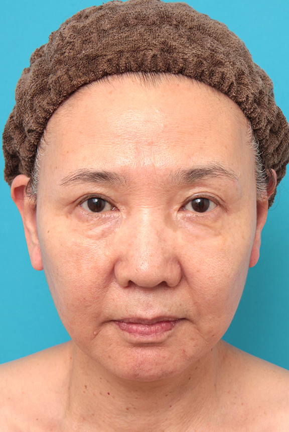 フルフェイスリフト,フルフェイスリフトを行った60代女性の症例写真,After（6ヶ月後）,ba_facelift007_b01.jpg