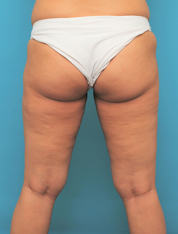 脂肪吸引,脂肪吸引の症例 お尻と太ももの脂肪吸引とバスト脂肪注入の30代女性,After（6ヶ月後）,ba_shibokyuin045_b04.jpg