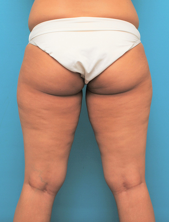 脂肪吸引,脂肪吸引の症例 お尻と太ももの脂肪吸引とバスト脂肪注入の30代女性,Before,ba_shibokyuin045_b04.jpg