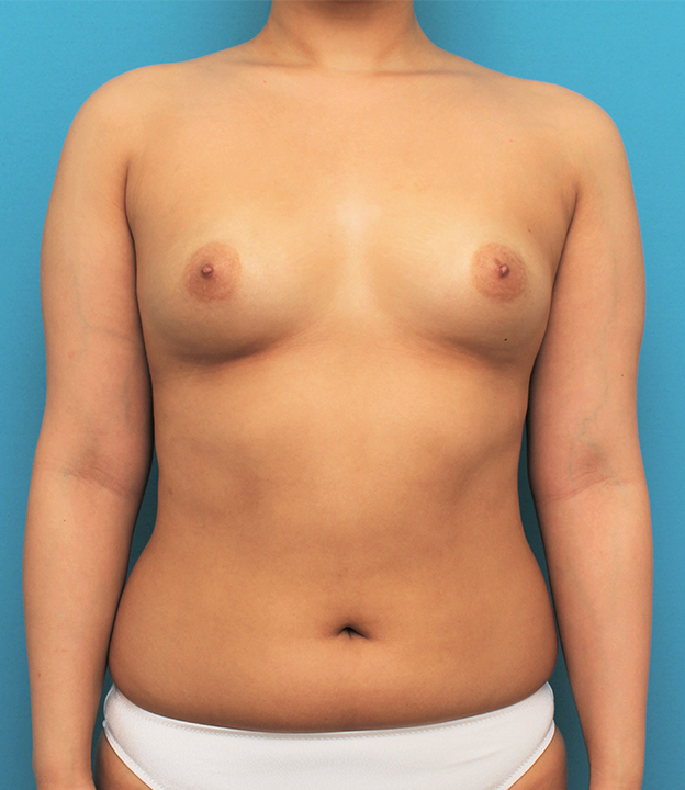 ピュアコンデンス脂肪注入豊胸,脂肪吸引の症例 お尻と太ももの脂肪吸引とバスト脂肪注入の30代女性,手術前,mainpic_shibokyuin045a.jpg