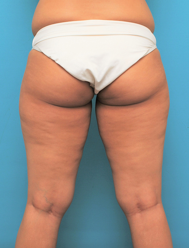 ピュアコンデンス脂肪注入豊胸,脂肪吸引の症例 お尻と太ももの脂肪吸引とバスト脂肪注入の30代女性,手術前,mainpic_shibokyuin045f.jpg
