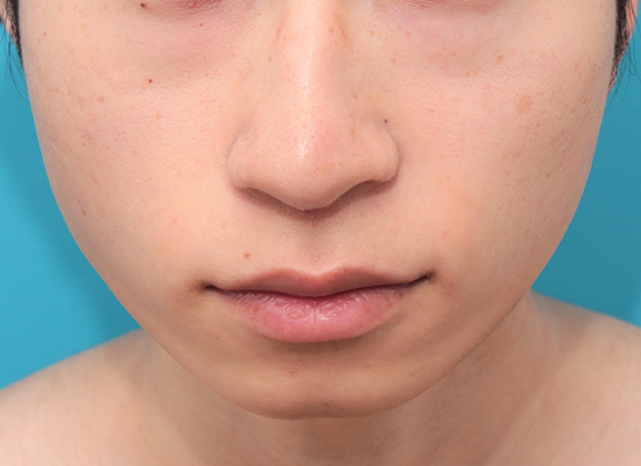 鼻の下を短く（上口唇短縮手術、上口唇リフト、リップリフト、人中短縮術）,人中短縮手術（リップリフト）で鼻の下を短くした20代男性の症例写真,After（2ヶ月後）,ba_hanashita006_b01.jpg