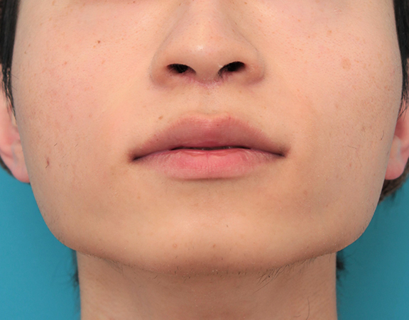 鼻の下を短く（上口唇短縮手術、上口唇リフト、リップリフト、人中短縮術）,人中短縮手術（リップリフト）で鼻の下を短くした20代男性の症例写真,After（2ヶ月後）,ba_hanashita006_b02.jpg