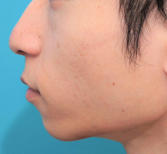 鼻の下を短く（上口唇短縮手術、上口唇リフト、リップリフト、人中短縮術）,人中短縮手術（リップリフト）で鼻の下を短くした20代男性の症例写真,After（2ヶ月後）,ba_hanashita006_b03.jpg