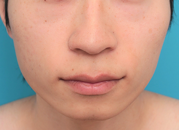 人中短縮手術（リップリフト）で鼻の下を短くした20代男性の症例写真,Before,ba_hanashita006_b01.jpg