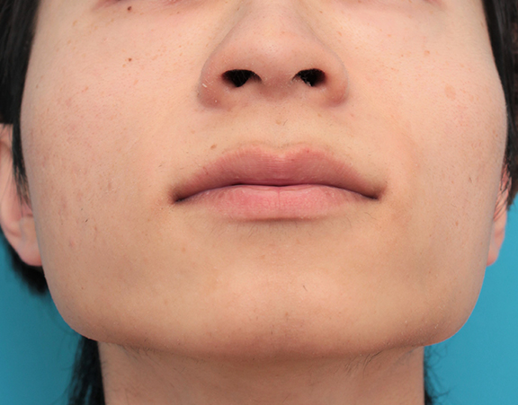 鼻の下を短く（上口唇短縮手術、上口唇リフト、リップリフト、人中短縮術）,人中短縮手術（リップリフト）で鼻の下を短くした20代男性の症例写真,Before,ba_hanashita006_b02.jpg