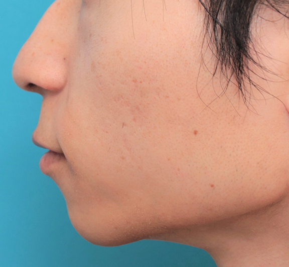 鼻の下を短く（上口唇短縮手術、上口唇リフト、リップリフト、人中短縮術）,人中短縮手術（リップリフト）で鼻の下を短くした20代男性の症例写真,Before,ba_hanashita006_b03.jpg