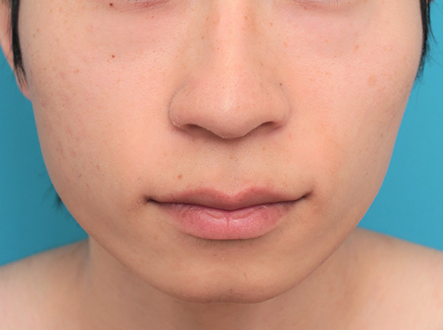 鼻の下を短く（上口唇短縮手術、上口唇リフト、リップリフト、人中短縮術）,人中短縮手術（リップリフト）で鼻の下を短くした20代男性の症例写真,手術前,mainpic_hanashita007a.jpg