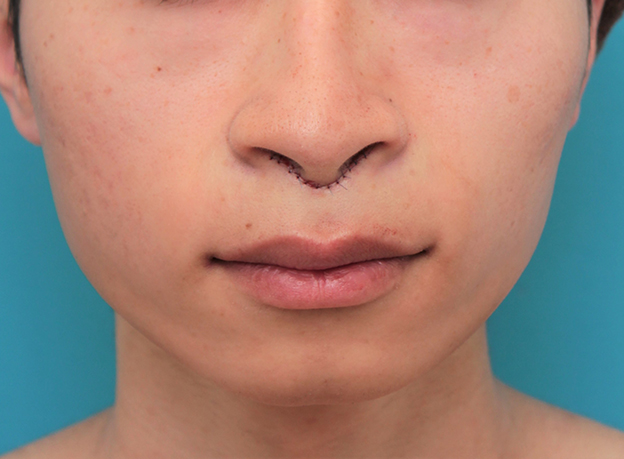 症例写真,人中短縮手術（リップリフト）で鼻の下を短くした20代男性の症例写真,手術直後,mainpic_hanashita007b.jpg