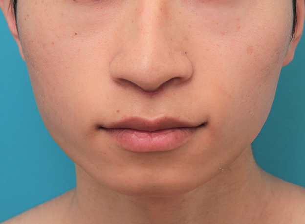 鼻の下を短く（上口唇短縮手術、上口唇リフト、リップリフト、人中短縮術）,人中短縮手術（リップリフト）で鼻の下を短くした20代男性の症例写真,6日後,mainpic_hanashita007c.jpg